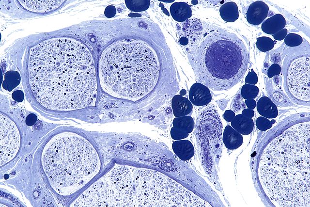 Small Fiber Neuropathy: Definition, Diagnosis, and Treatment